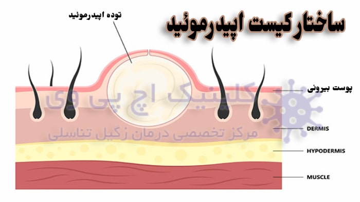 عکس ساختار کیست اپیدرموئید