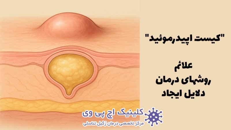 عکس کیست اپیدرموئید