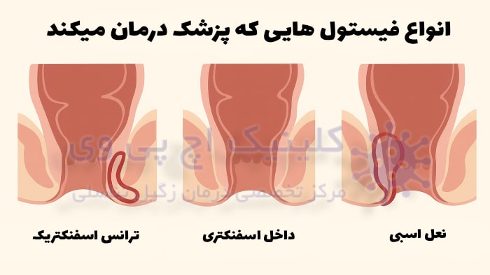 عکس بهترین جراح فیستول در ایران