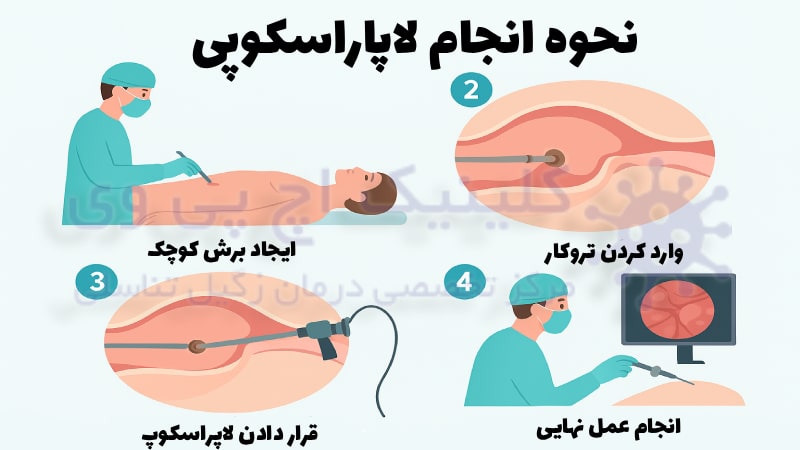 عکس نحوه انجام لاپاراسکوپی